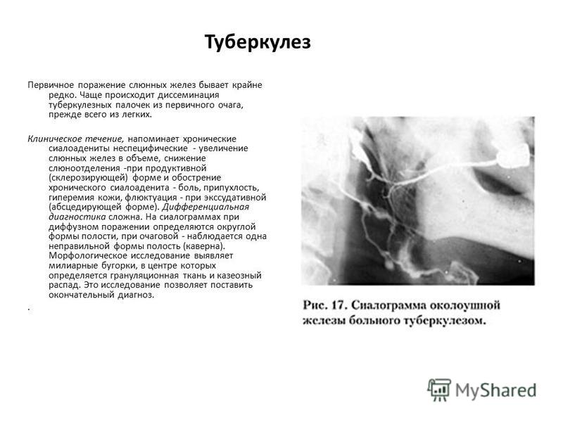 Заболевания слюнных желез у детей презентация