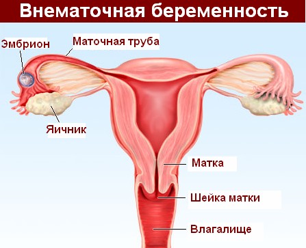Схема внематочной беременности