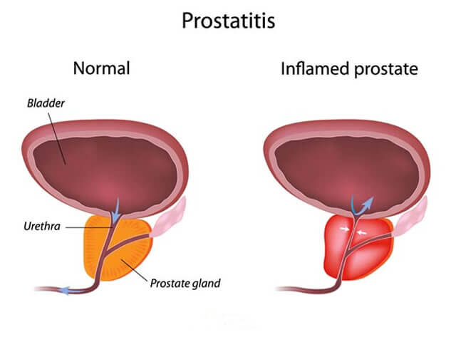 Схема развития простатита