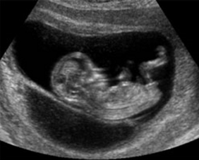 Беременность на третьем месяце фото