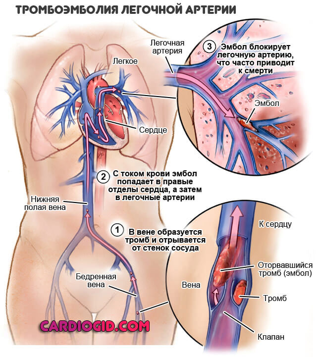 тромбоэмболия-легочной-артерии