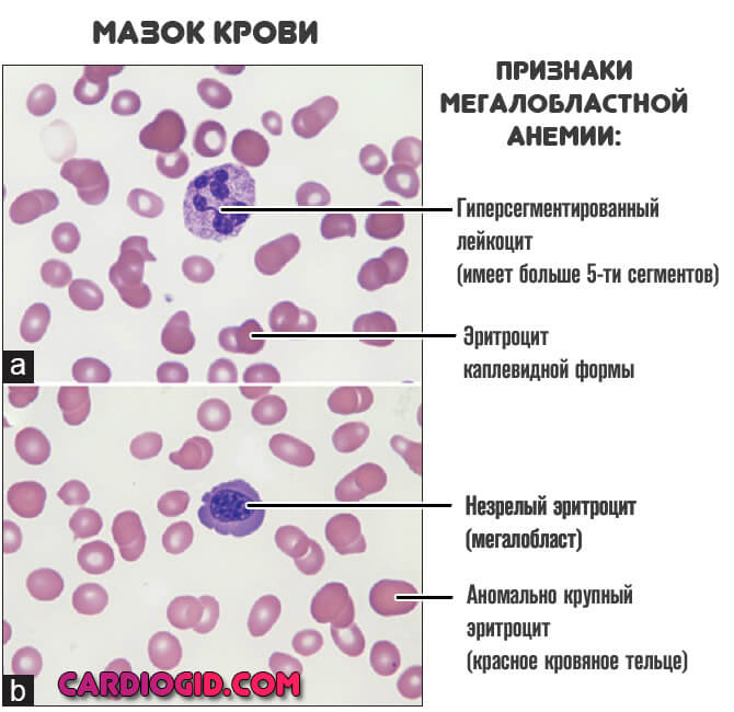 признаки мегалобластной анемии в мазке крови