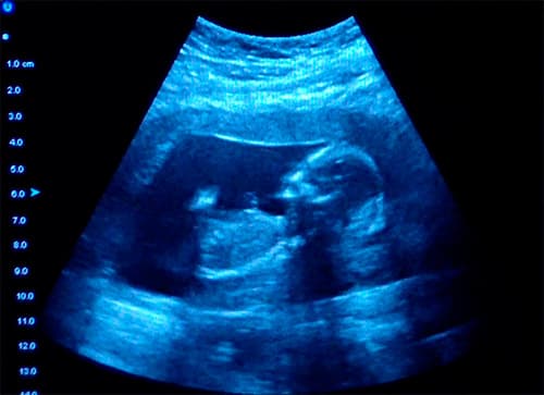 фото узи на 4 месяце беременности