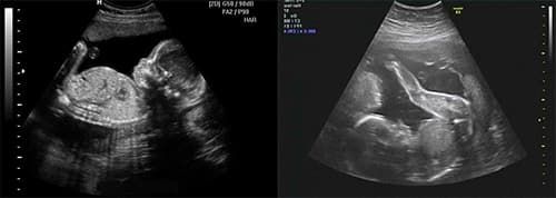 5 месяцев беременности фото плода на узи