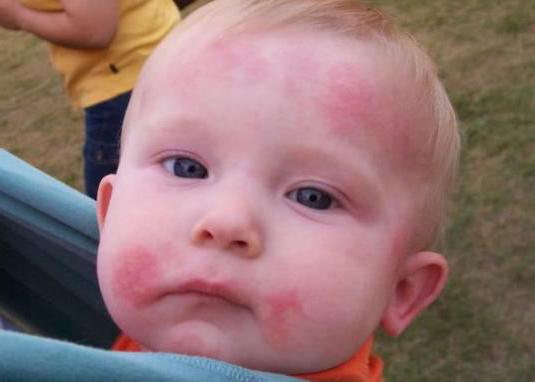 аллергия на молоко у ребенка симптомы 