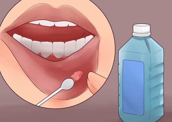 ретенционная киста нижней губы операция