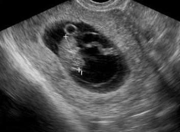 эмбрион узи 6 недель