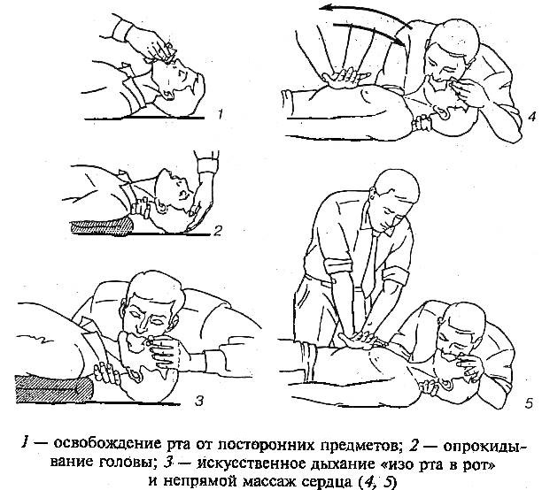 Дыхательная недостаточность. Классификация по степени тяжести у детей. Признаки, неотложная помощь, лечение