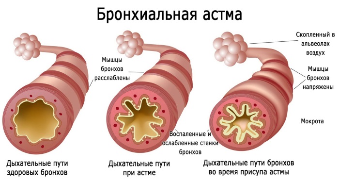 Дыхательная недостаточность. Классификация по степени тяжести у детей. Признаки, неотложная помощь, лечение