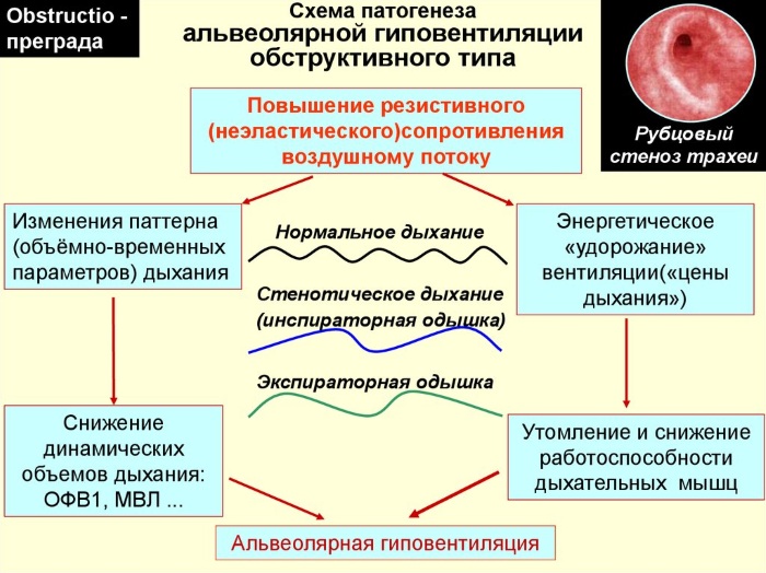 Дыхательная недостаточность. Классификация по степени тяжести у детей. Признаки, неотложная помощь, лечение