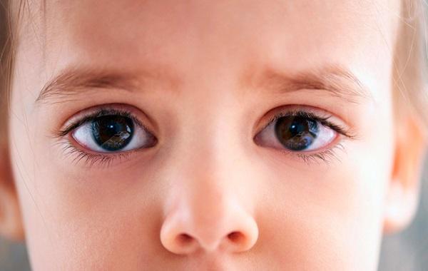 У ребенка разные размеры глаз