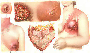 Гипертрофия груди