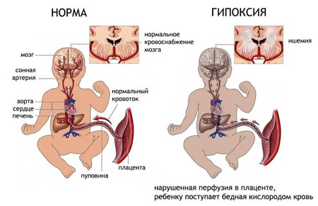 Гипоксия плода