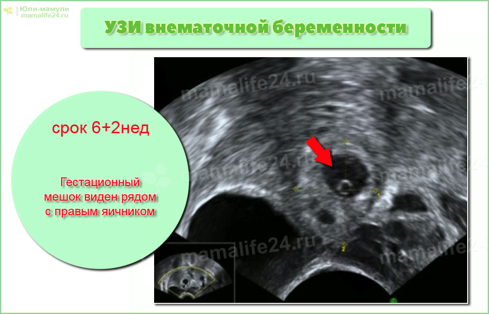 Ультразвуковое изображение правой трубы на 6 + 2 неделе внематочной беременности. Гестационный мешок виден рядом с правым яичником. 