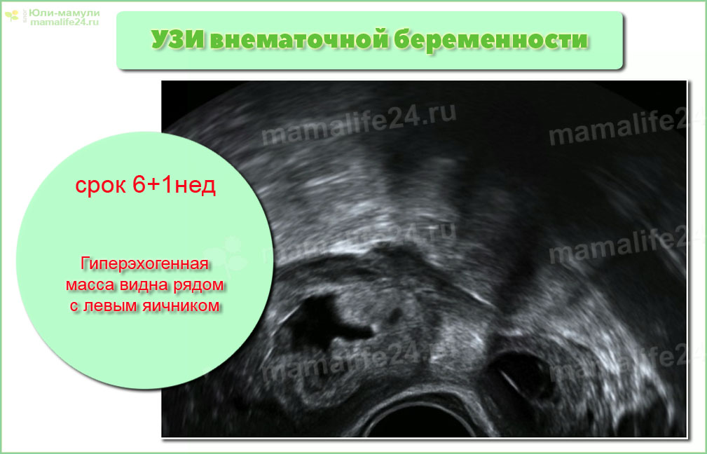 Ультразвуковое изображение области левой трубы на 6 + 1 неделе внематочной беременности. Гиперэхогенная масса видна рядом с левым яичником.