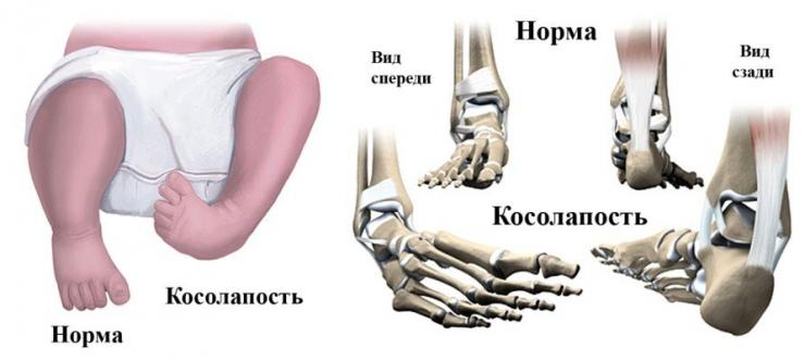 Методы исправления врожденной косолапости у детей