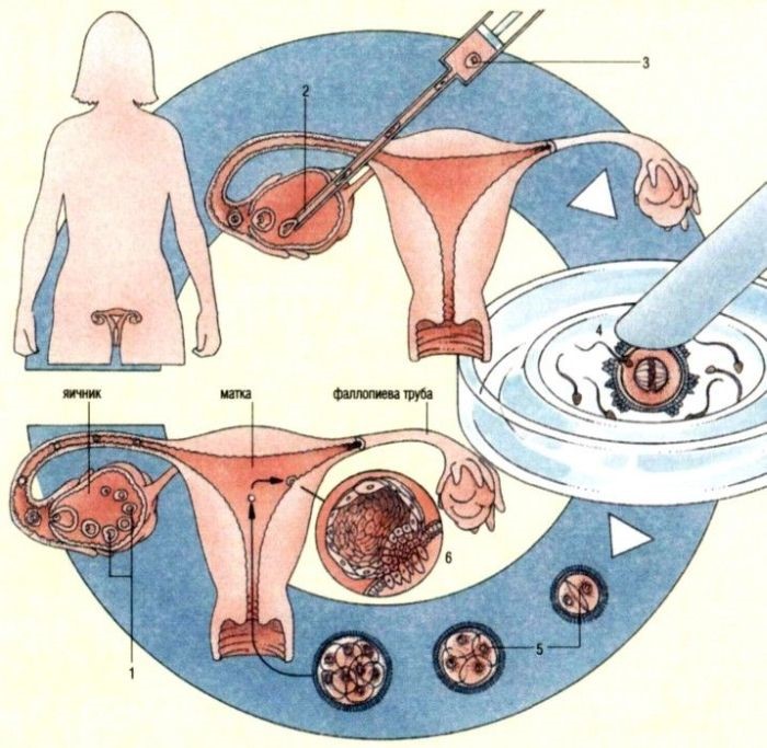 Искусственное оплодотворение для одиноких женщин