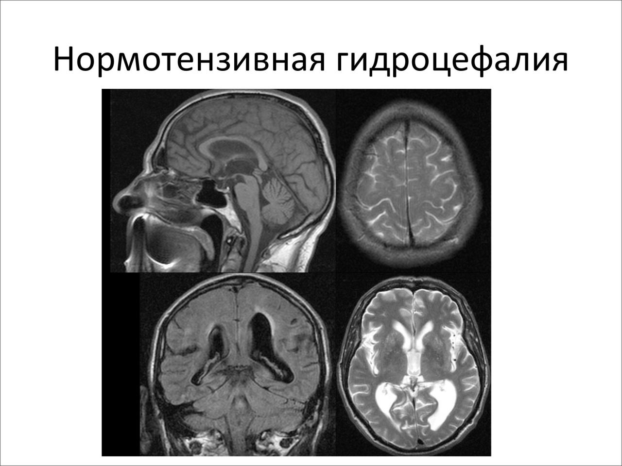 Причины гидроцефалии мозга
