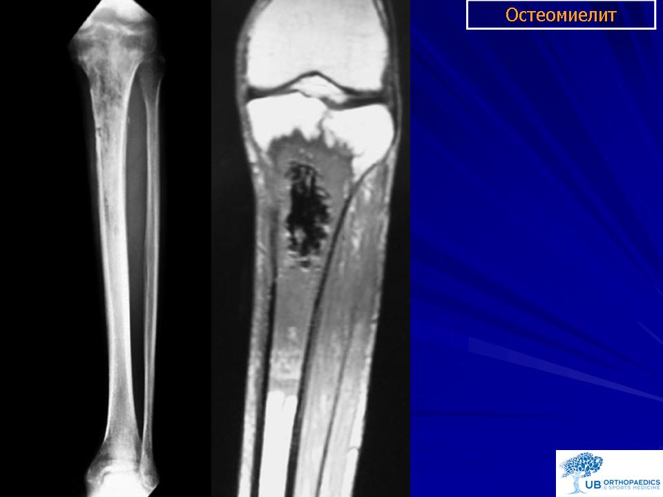 Огнестрельный остеомиелит. Острый остеомиелит рентген большеберцовой кости. Гематогенный остеомиелит рентген.