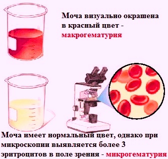 Как выявить кровь в моче