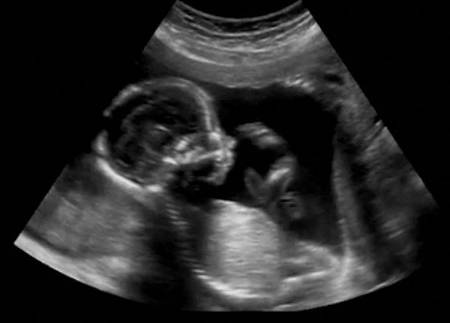 Беременность 17 недель мальчик или девочка