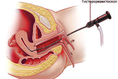 Удаление полипа эндометрия гистероскопия