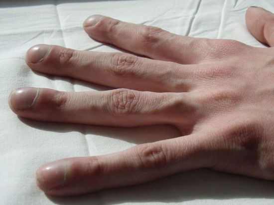 Пальцы при муковисцидозе