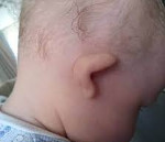 Аномалии развития ушной раковины